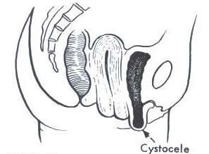 Cystocele or anterior wall prolapse