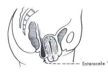 Enterocele