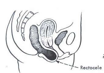 Rectocele or posterior vaginal wall prolapse